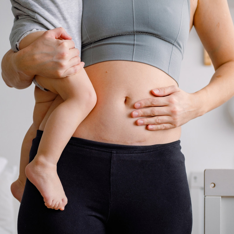Why Caesarean Awareness Month Matters