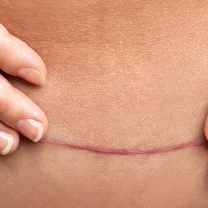 From Monitoring to Delivery: Caesarean Best Practices and Risks
