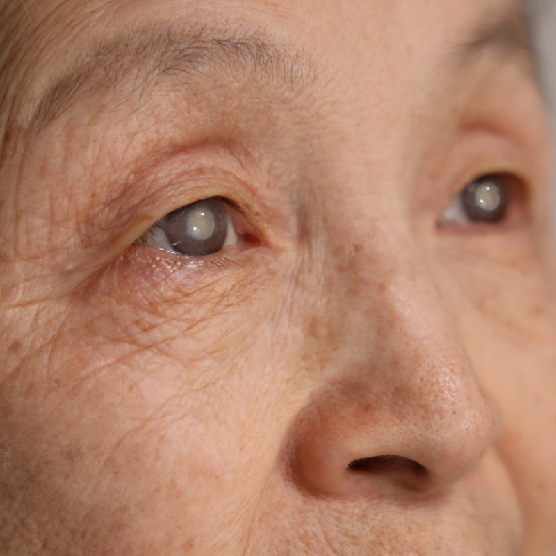 The Hidden Cost of Delay: When Cataract Diagnosis Comes Too Late